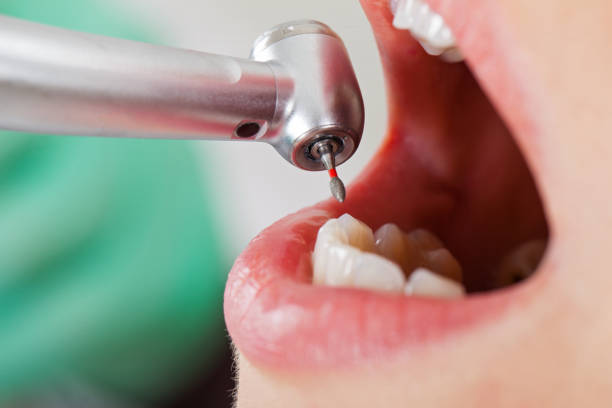 Best Emergency Tooth Extraction in Whiteman Af, MO